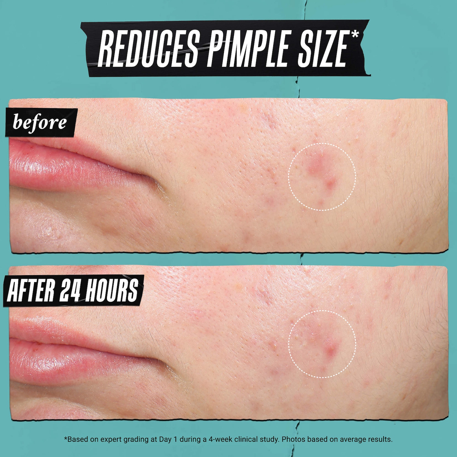 Kiehl’s Since 1851 – Truly Targeted Acne-Clearing Liquid Pimple Patch with Salicylic Acid