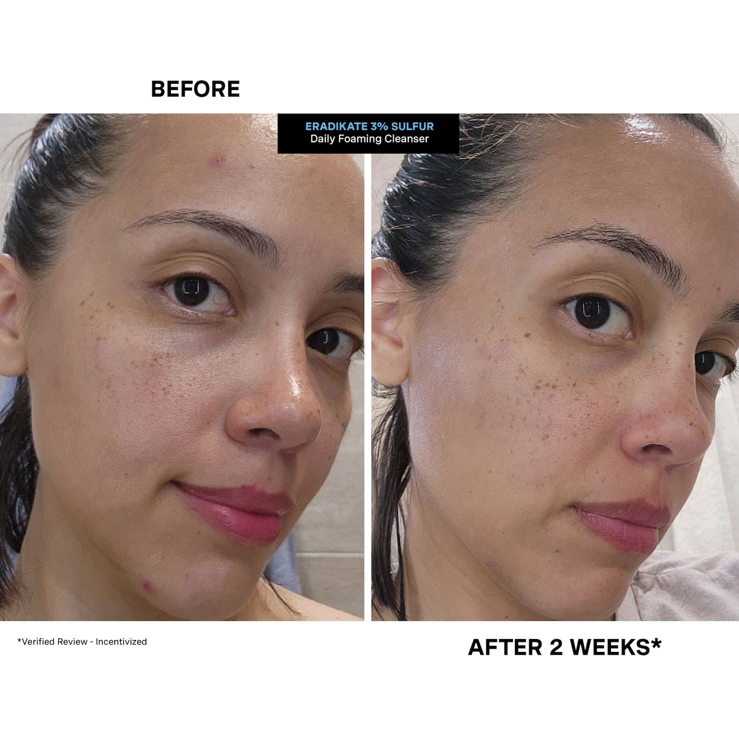 Kate Somerville – Mini EradiKate™ Daily Cleanser with Sulfur Acne Treatment